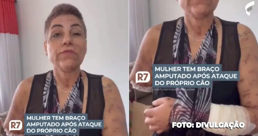 caso semelhante, uma mulher teve o braço amputado