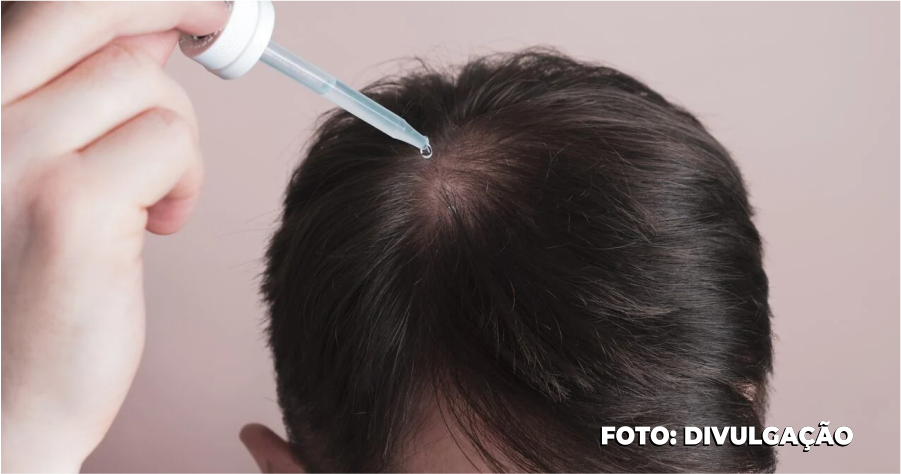 Uso de Minoxidil para Crescimento Capilar: Eficácia Comprovada